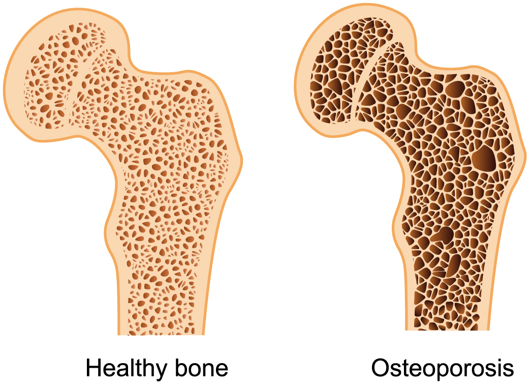 Osteoporosis Is A Bone Disease
